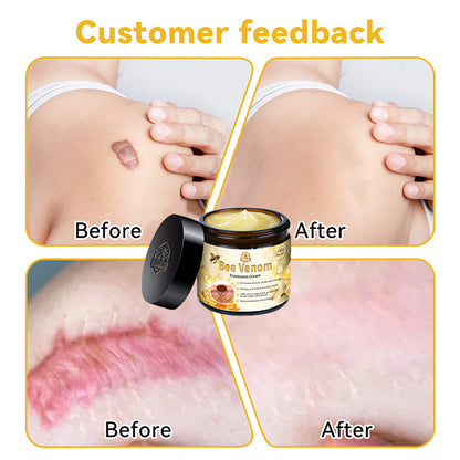 Turonu™ Bee Venom Skin Cream Australian College of Dermatology (ACD) approved (helps treat acne, warts, rosacea, psoriasis, age spots, eczema and reduces the appearance of stretch marks)🍀