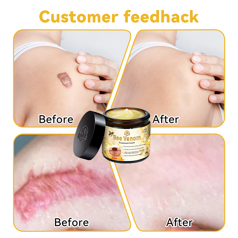 Turonu™ Bee Venom Skin Treatment Cream Approved by the Australasian College of Dermatologists (ACD) (Helping with acne, warts, rosacea, psoriasis, age spots, eczema, and reducing the appearance of stretch marks) 🏵️